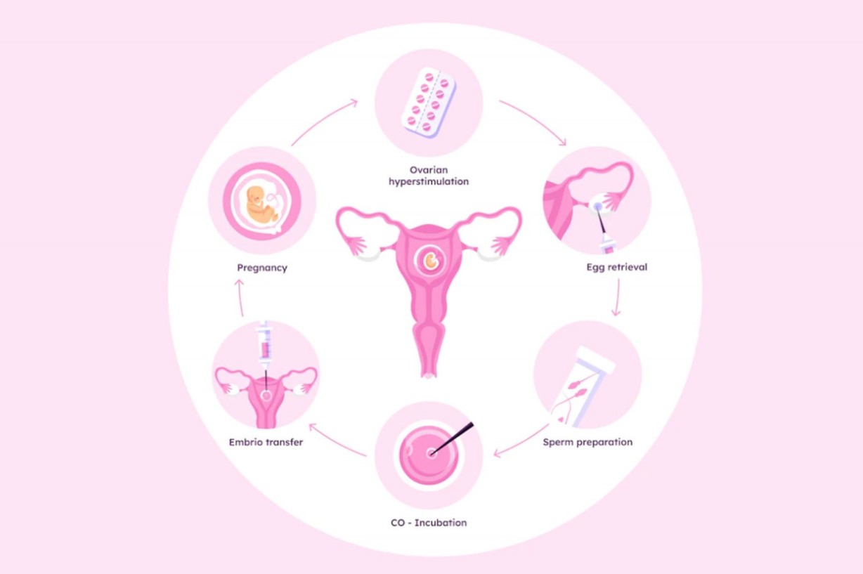 IVF Process: Step by Step
