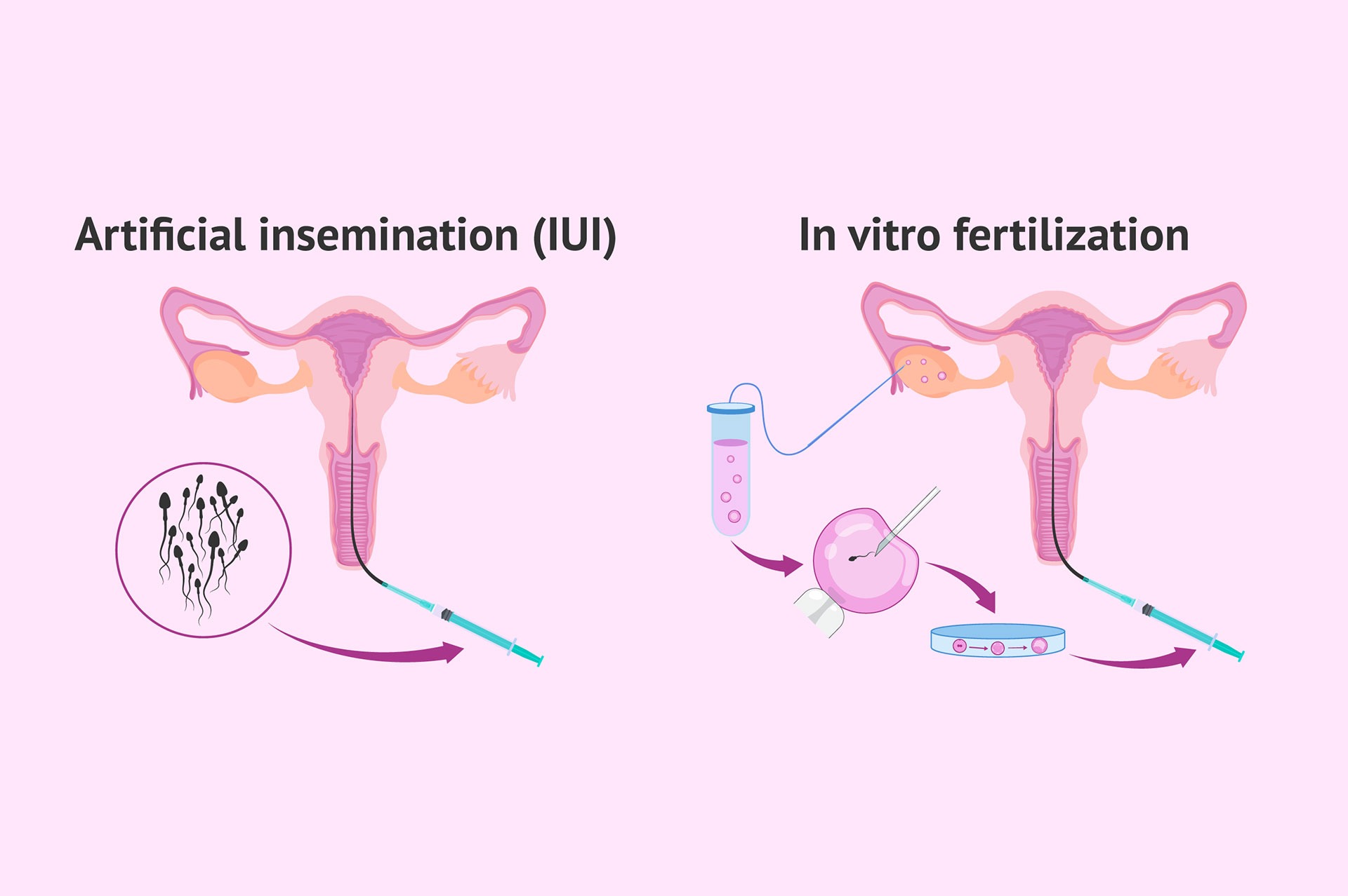Difference Between IVF And Artificial Insemination