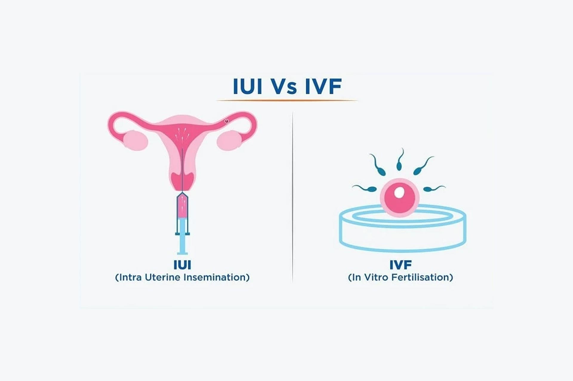Difference Between IUI & IVF